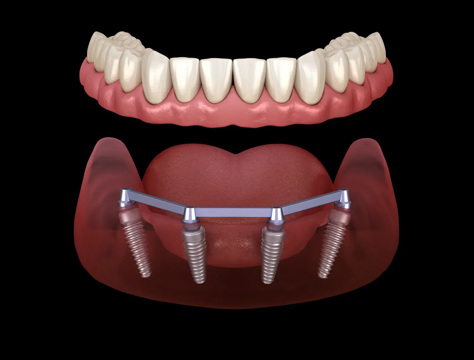 Photo related to dental implant