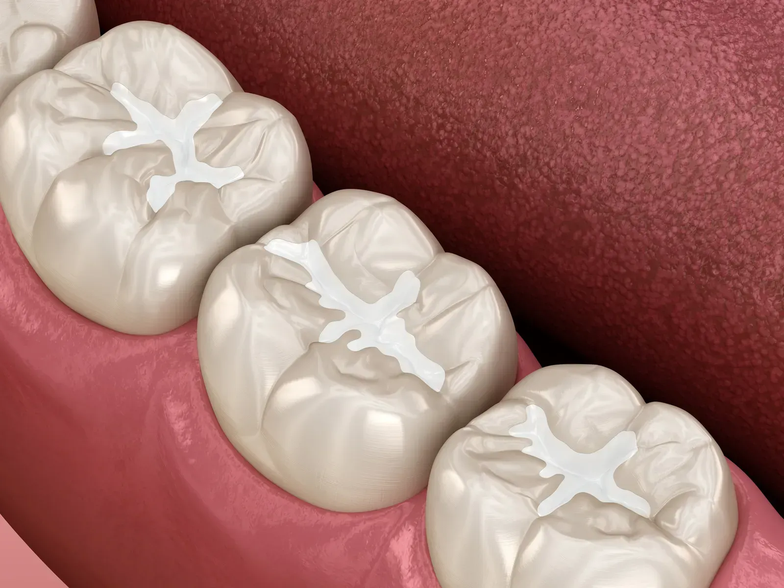 Photo related to dental sealants